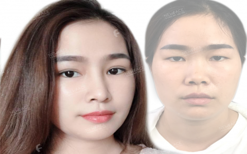 Bác sĩ chuyên sâu phẫu thuật nâng mũi: Công nghệ nâng mũi bằng sụn sườn tự thân - xu hướng thẩm mỹ mũi an toàn và bền vững