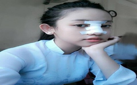Phẫu thuật nâng mũi có lợi ích gì và hệ lụy gì?