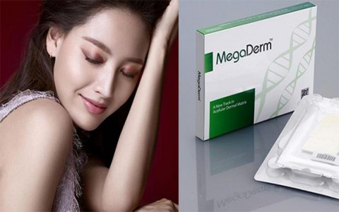 Công nghệ nâng mũi cấu trúc bọc megaderm có tốt không?