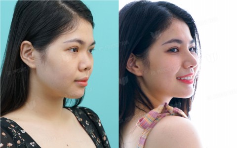 Review chân thật của cô nàng tiếp viên hàng không: “Nâng mũi được trả lại video quay lại toàn bộ quá trình”