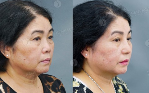 “Làm đẹp không bao giờ là trễ” - Thông điệp của nữ Việt Kiều khi quyết định nâng mũi ở tuổi 63