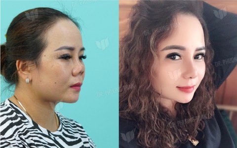 Cô nàng có chiếc mũi biến dạng được “giải cứu” bằng phương pháp nâng mũi cấu trúc sụn sườn