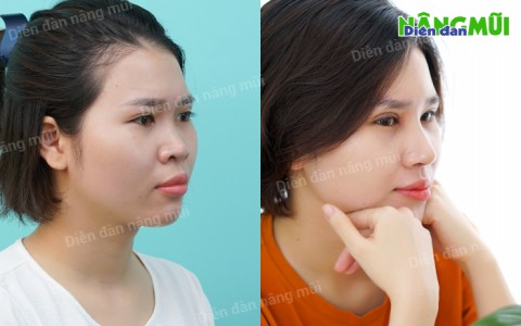 Tạm biệt góc nghiêng “thần sầu”, cô gái “lột xác” nhờ phương pháp nâng mũi sụn sườn