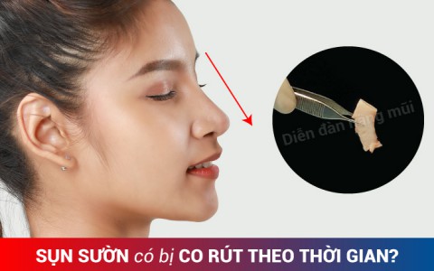 Thực hư nỗi lo: Sụn sườn có bị co rút theo thời gian không?