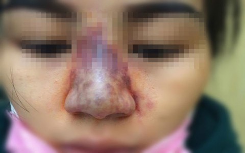 Thủng mũi, hoại tử da khi nâng mũi tại Spa “chui”