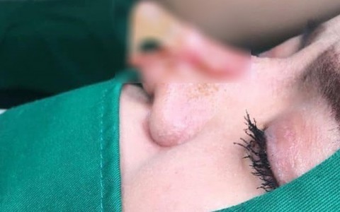 Kinh hãi trước hình ảnh thủng mũi, lòi sụn khó lòng cứu vãn của cô gái 9X