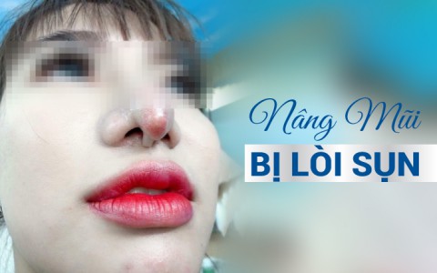 Hoảng hồn cô gái nâng mũi bị lòi sụn trông chẳng khác gì “răng mọc trên mũi”