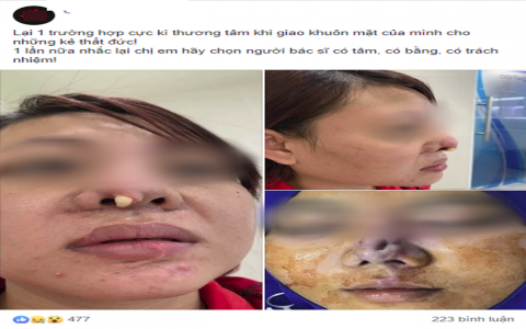 Chị em mê dao kéo sém "ngất xỉu" trước chiếc mũi hỏng kinh dị của bà mẹ trẻ