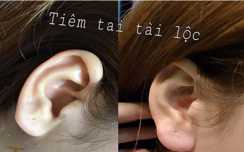 Coi chừng mất Tết vì "tiêm tai tài lộc"!