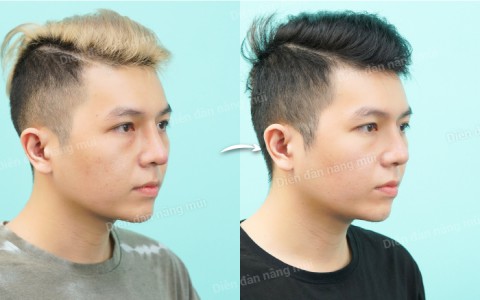“Trung bì mỡ - “Cứu tinh” chiếc mũi bị nhiễm trùng sau 2 lần nâng mũi của chàng trai trẻ