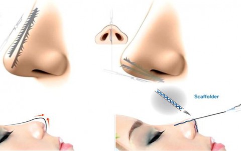 Nâng mũi bằng chỉ: Nhanh, rẻ nhưng kém an toàn