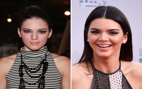 Siêu mẫu lừng danh Kendall Jenner từng "chỉnh sửa nhan sắc" như thế nào?