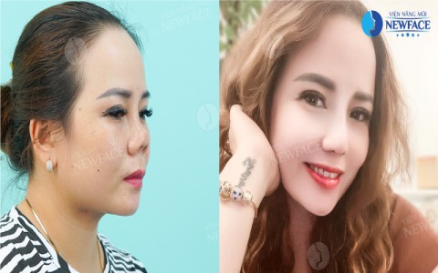 Viện nâng mũi Newface và ca phẫu thuật làm mũi hỏng