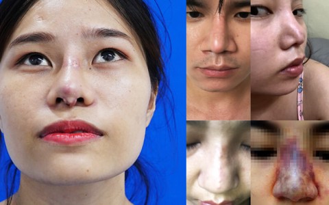 Khách hàng nâng mũi hỏng? Chia sẻ từ Bác sĩ Trần Phương