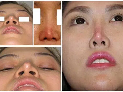 “Bóc trần” sự thật về sụn nâng mũi không cần phẫu thuật