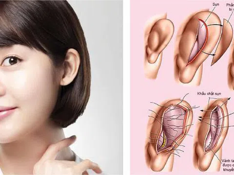 Nâng mũi cấu trúc sụn tai cần lưu ý những gì?