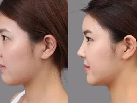 Nâng mũi sụn 3D - Giải pháp hoàn hảo để sở hữu dáng mũi đẹp mọi góc nhìn