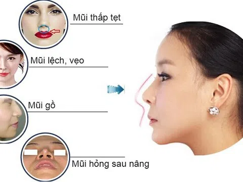 Top 5 câu hỏi thường gặp về nâng mũi sụn sườn