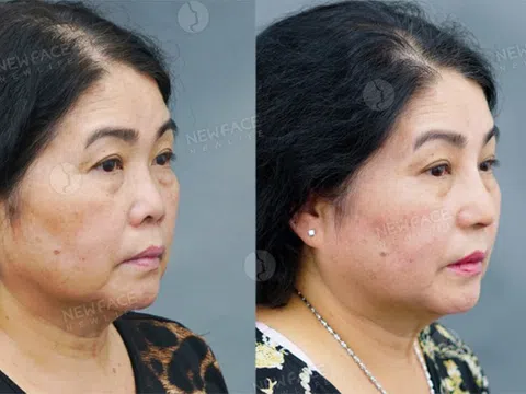 “Làm đẹp không bao giờ là trễ” - Thông điệp của nữ Việt Kiều khi quyết định nâng mũi ở tuổi 63 